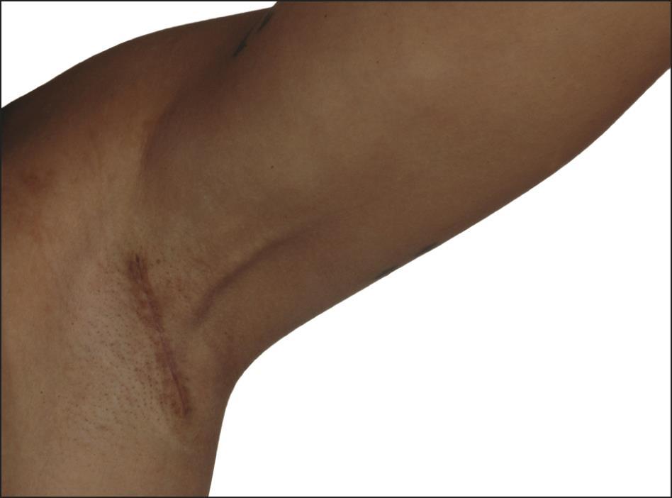 Późne następstwa leczenia raka piersi Axillary Web Syndrom Zaburzenia czucia Bóle i czucie fantomowe Wady postawy