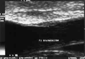 Ultrasonograficzne obrazy tętnicy szyjnej odpowiadające klasom biopsji