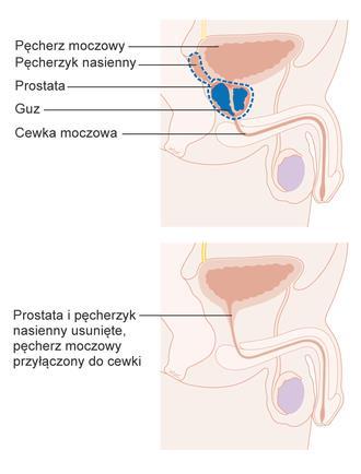 Leczenie raka prostaty Celem operacji jest usunięcie całego nowotworu z wolnym od nacieku nowotworowego marginesem chirurgicznym Prostatektomia - wycięcie całego gruczołu krokowego wraz z