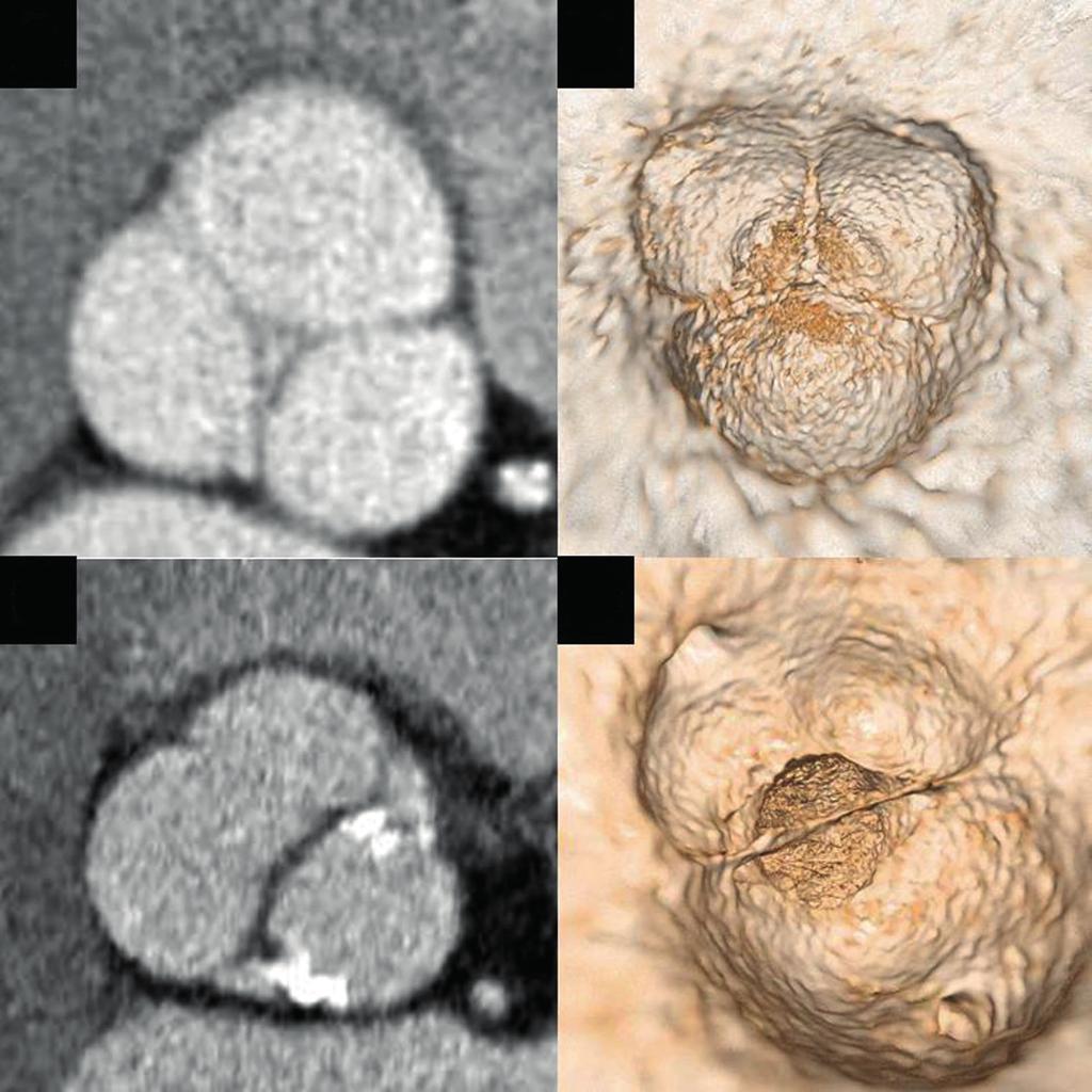 C D Ryc. 2. adanie CT., prawidłowa zastawka aortalna, C, D zastawka aortalna dwupłatkowa, zwapnienia płatków zastawki Fig. 2. CT scan.
