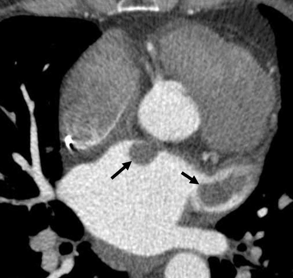 ambulatoryjnych nie należy do rzadkości, zwłaszcza u pacjentów z wywiadem choroby nowotworowej [1]. Ryc. 5. adanie CT, skrzepliny w lewym przedsionku (strzałki) Fig. 5. CT scan.