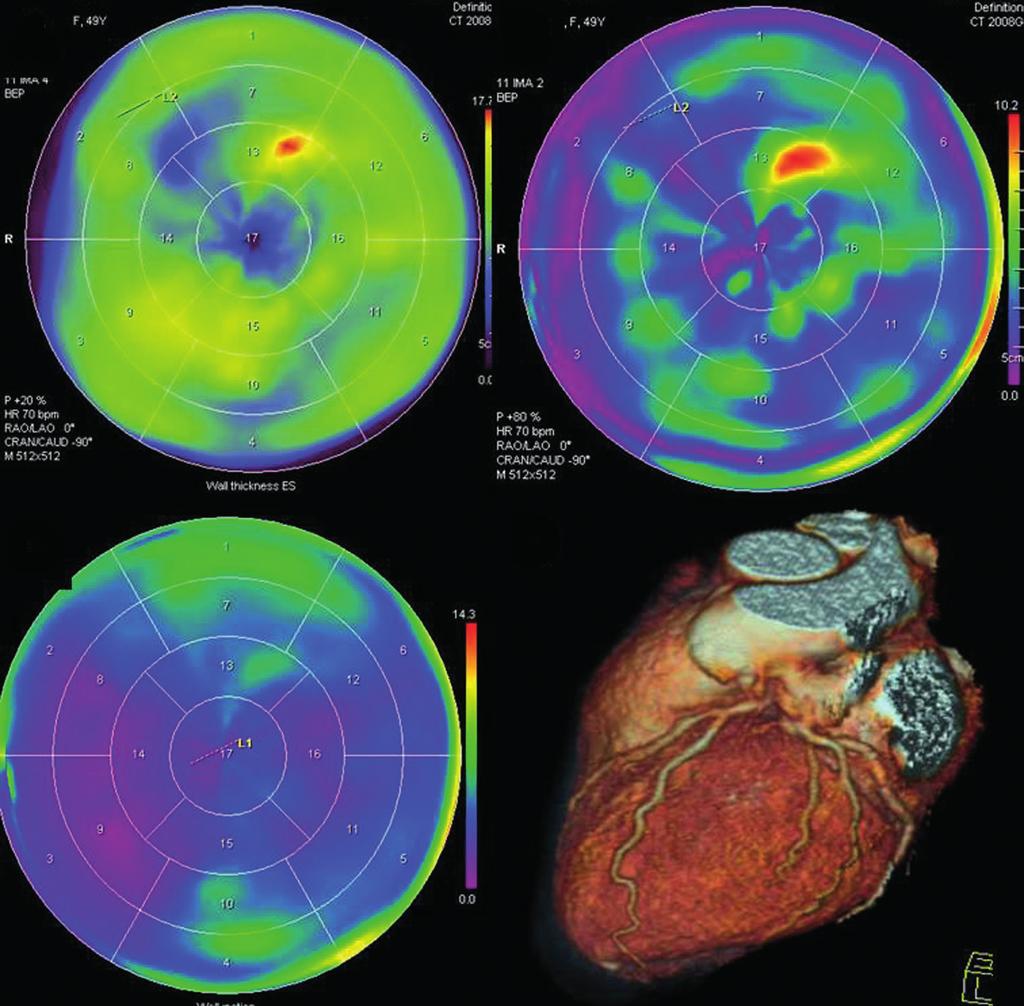 C Ryc. 7. adanie CT. Ocena funkcji lewej komory. Graficzna prezentacja grubości mięśnia (), grubienia () i ruchomości (C) Fig. 7. CT scan. Cardiac function analysis.
