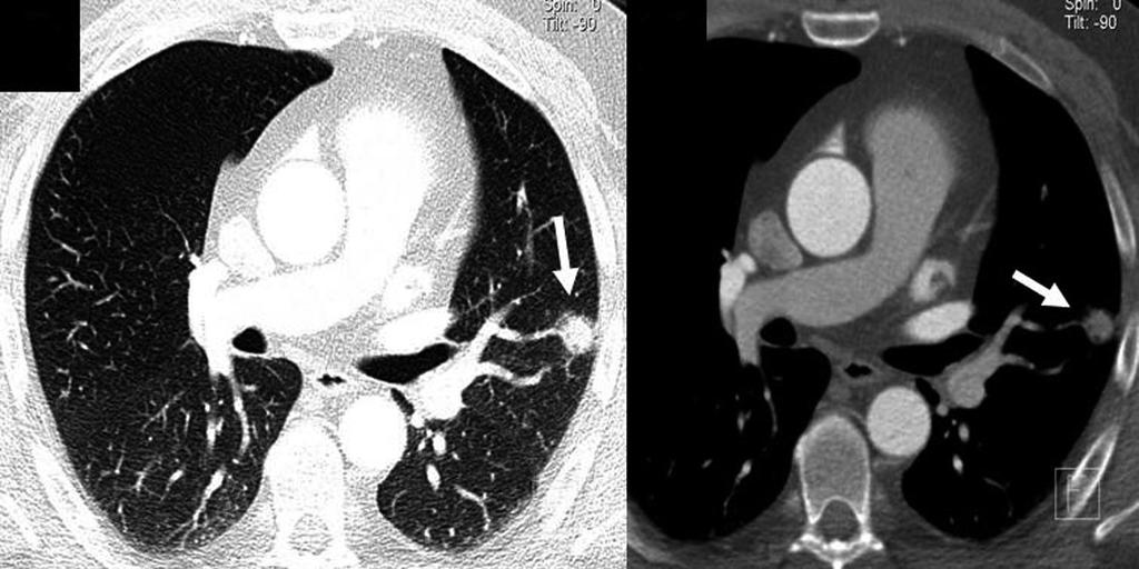 [11] 2002 ECT 1326 7,8 Onuma et al. [12] 2006 16 i 64 MDCT 503 58,1 Mueller et al. [13] 2007 16-MDCT 259 13 Kirsch et al. [14] 2007 64 MDCT 100 67 urt et al.