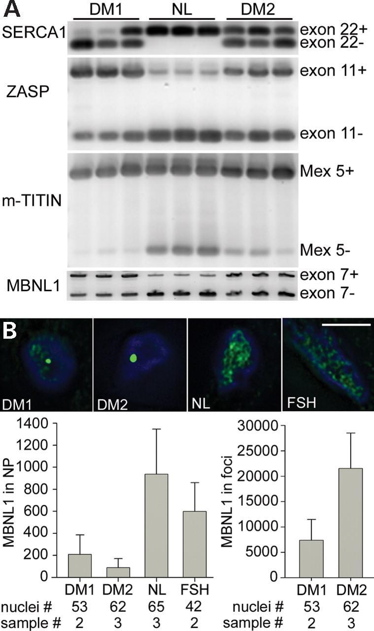 Splicing defect and nuclear sequestration of MBNL1 protein in