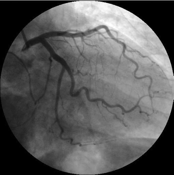 ostrego zespołu wieńcowego (ACS, acute coronary syndrome).