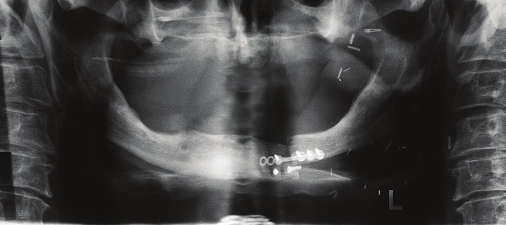 Implant treatment of an edentulous patient after tumour removal in the craniofacial area case report J Stoma 2015; 68, 3 Fig. 1.
