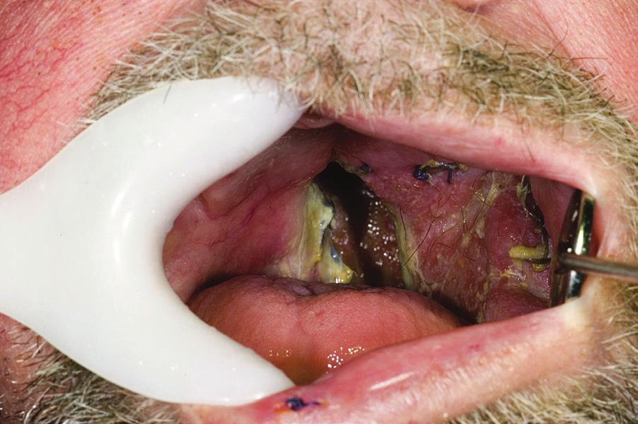 Intraoral image before the prosthodontic treatment showing large hard and soft palate tissue loss.