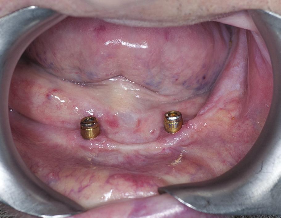 J Stoma 2015; 68, 3 Rolski D., Nieborak R., Gładkowski J., Bojczuk A., Mateńko D., Starościak S., Mierzwińska-Nastalska E. using the indirect technique.