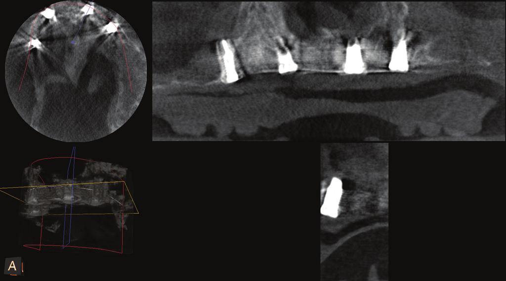 In order to improve retention of the postoperative complete upper denture it was decided to insert four implants in the maxilla.