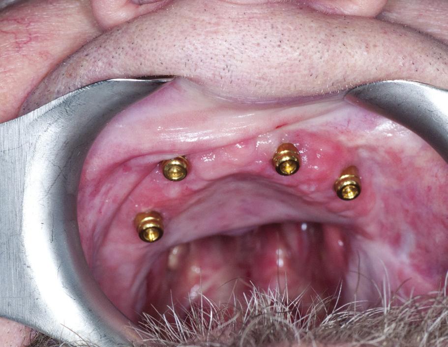 Implant treatment of an edentulous patient after tumour removal in the craniofacial area case report J Stoma 2015; 68, 3 Fig. 5.