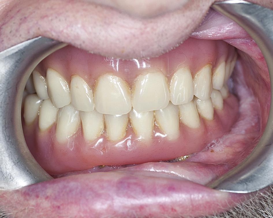 The results for each implant were as follows: implant in position 14: -1, -1, -3 (Periotest) and 65, 64, 63 (Osstell Mentor); implant in position 12: -1, -1, -1 (Periotest) and 58, 58, 58 (Osstell