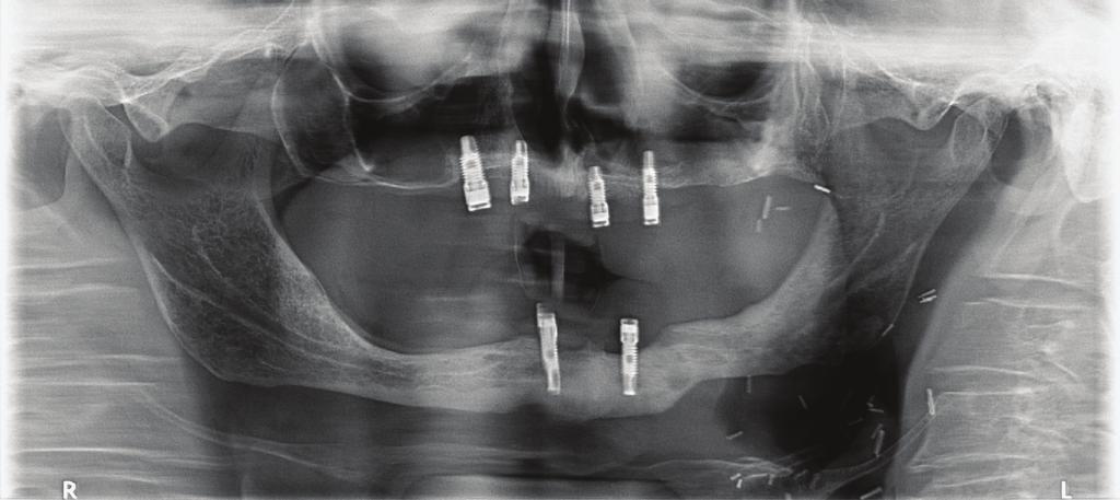 J Stoma 2015; 68, 3 Rolski D., Nieborak R., Gładkowski J., Bojczuk A., Mateńko D., Starościak S., Mierzwińska-Nastalska E. Fig. 9.