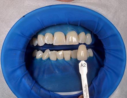 powierzchnie zębów.