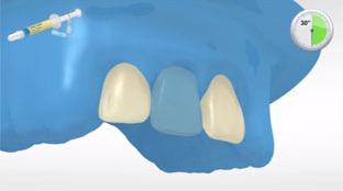 5 Wstępne opracowanie powierzchni zęba i aplikacja materiału łączącego Opcjonalny: Najpierw wytrawić opracowane szkliwo stosując Total Etch (37% kwas ortofosforowy w postaci żelu), a potem