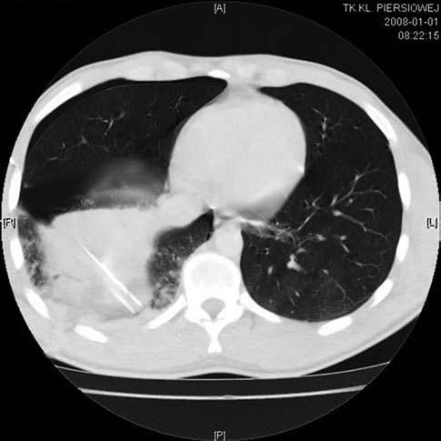 Chest CT scan of a gunshot wound showing parenchymal laceration of the right lung (hematoma) (arrow marks the focus of the wound with fixed drainage chest tube) Rycina 6.