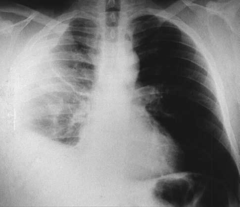 Chest X ray of a gunshot wound showing right hemothorax (arrow indicates the lesion) 5 (5,9 %) 4 (4,7%) 10 (11,7%) 22 (25,9%) 63 (74,1%) Rycina 7.