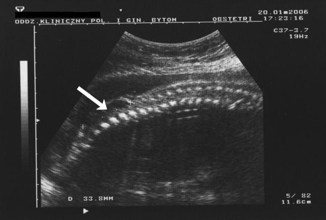 PRENATALNA OPERACJA PRZEPUKLINY OPONOWO-RDZENIOWEJ SZANSA NA POPRAWĘ JAKOŚCI ŻYCIA Tabela 1.
