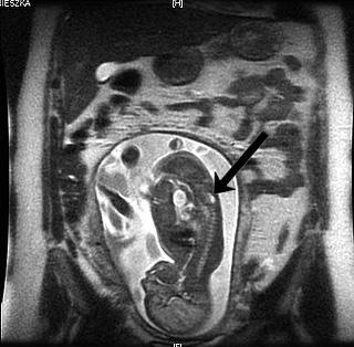 Agnieszka Pastuszka et al. Ryc. 4. Badanie MRI płodu - widoczny rozszczep kręgosłupa w odcinku L-S. zamknięcia przepukliny oponowo-rdzeniowej jeszcze w życiu płodowym.