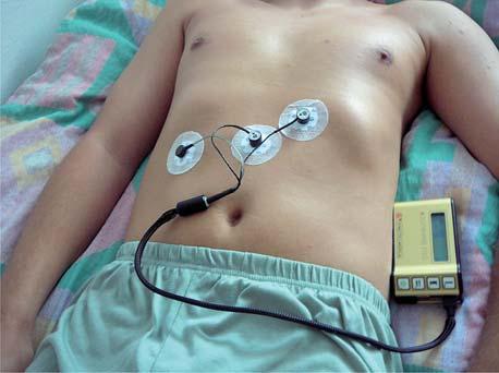 Elektrogastrografia w diagnostyce dyspepsji czynnościowej 145 padłej do linii pośrodkowej ciała, 10 cm w prawo od elektrody pierwszej na tej samej wysokości (ryc. 1.).