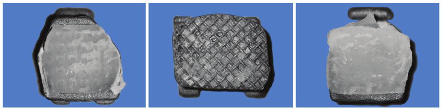 In a previous report it has been suggested that re-used brackets can demonstrate higher shear bond strength than new brackets 21 though other studies showed that bond strengths of previously failed