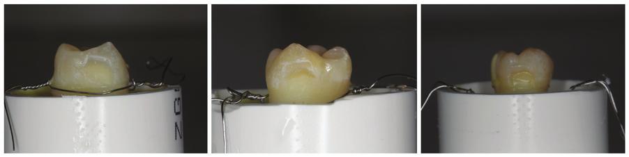 22 Williams and Carels 23 reported that the effect of sandblasting depends on the bracket type and was significant only in the case of brackets with integral bases (increase in shear bond strength).