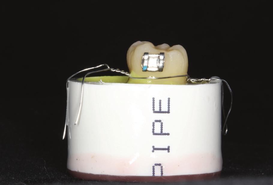Variations in orthodontic bracket retention related to base design... J Stoma 2016; 69, 6 Fig. 2. Sample (tooth with bracket embeded in the acrylic block).