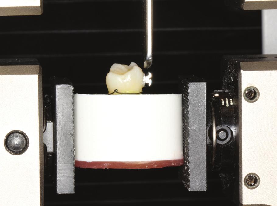 to force by an upper movable unit, acting with the speed of 0.5 mm/min. Results (in Newtons) were recorded on a connected computer system at the moment of debonding of the bracket.