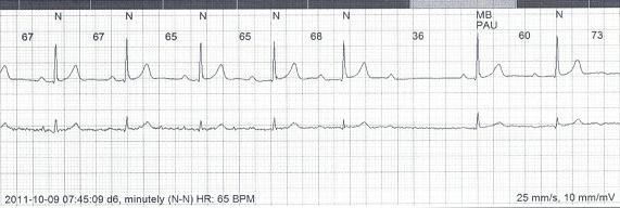 Choroby Serca i Naczyń 2012, tom 9, nr 4 Rycina 1. Blok przedsionkowo-komorowy II stopnia typu Mobitz I (periodyka Wenckebacha) Rycina 2.