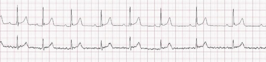 Ciągły zapis EKG po rejestrowanym bloku przedsionkowo-komorowym przedstawionym na rycinie 3