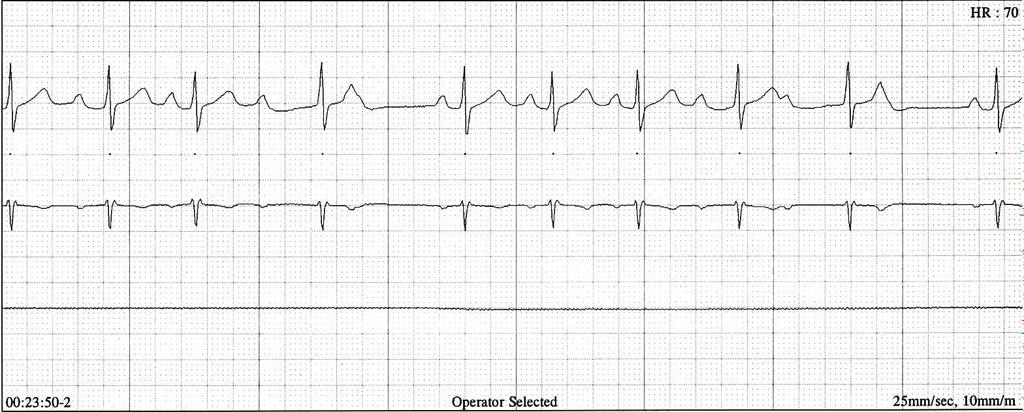 Wymaga natomiast okresowej kontroli i powtarzania 24 48-godzinnej rejestracji EKG. Wracając do nietypowego obrazu EKG (ryc. 3), według mnie trzeba rozważać dwie możliwości.