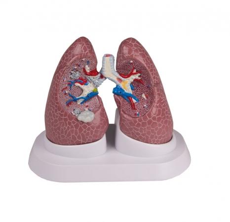 Model płuca z różnymi patologiami Nr ref: MA01076 Informacja o produkcie: Model