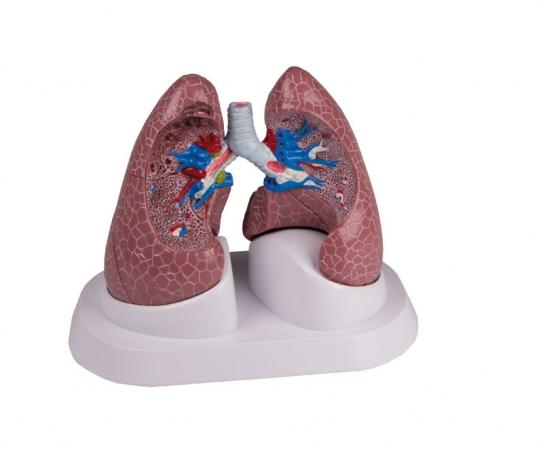 przedstawiający dwa płuca o budowie prawidłowej oraz płuca zmienione patologicznie