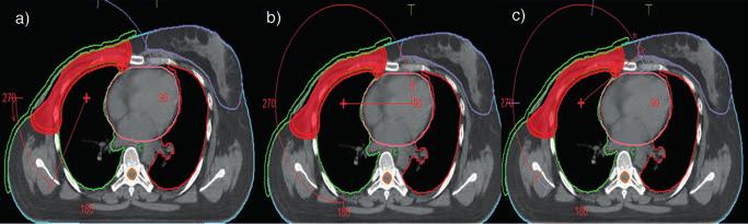 radioterapia \ radiotherapy artykuł naukowy \ scientific paper Fot. 4 Różnorodność kształtu obszaru PTV w płaszczyznach poprzecznej oraz czołowej. Target zaznaczono kolorem czerwonym.
