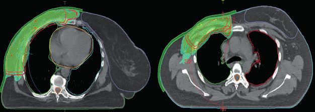 artykuł naukowy / scientific paper radioterapia / radiotherapy Tabela 1 Wybrane parametry przykładowych planów radioterapii ściany klatki piersiowej lub gruczołu piersiowego z SPL Monaco v.5.000.