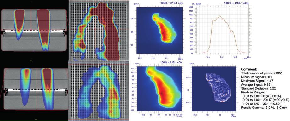 radioterapia \ radiotherapy artykuł naukowy \ scientific paper w stosunku do pacjentek szczupłych znacznie mniejszą objętościowo tkankę płucną, przy czym objętość obszaru tarczowego jest bardzo różna.