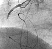 Opisy przypadków Przypadek 1 Chorego w wieku 82 lat, z wywiadem dławicy stabilnej, zaliczonego do II klasy według Coronary Cardiovascular Society (CCS) od około 15 lat, z nadciśnieniem tętniczym i