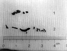 Folia Cardiol. 2005, tom 12, nr 4 Rycina 4. Usunięte za pomocą systemu DIVER fragmenty skrzeplin z tętnic wieńcowych Figure 4.