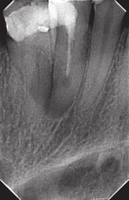 Treatment of internal inflammatory root resorption based on own observations J Stoma 2015; 68, 3 Fig. 1. Tooth 13 before treatment. Ząb 13 przed leczeniem. Fig. 2. Tooth 13 with calcium hydroxide.