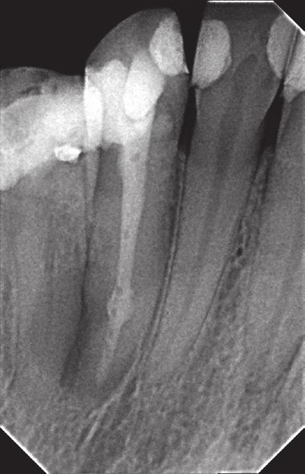 Ząb 13 kontrola po 12 miesiącach. root canal as an antiseptic dressing for a period of three weeks (Fig. 2). The access cavity was restored with a glass ionomer cement filling GIZ (Dr.