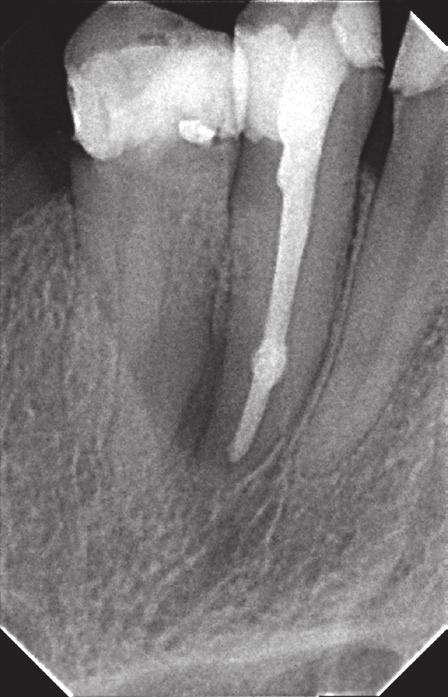 After this period, the step-back preparation with Kerr files was performed, with MAF 35 according to ISO, and then finally filled using the cold lateral gutta-percha condensation method with AH Plus