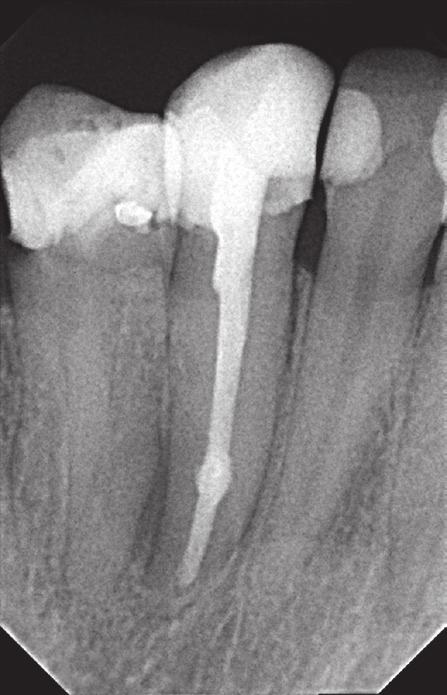 A follow-up radiograph was obtained to assess the treatment results after twelve months from the time of filling the canal permanently.