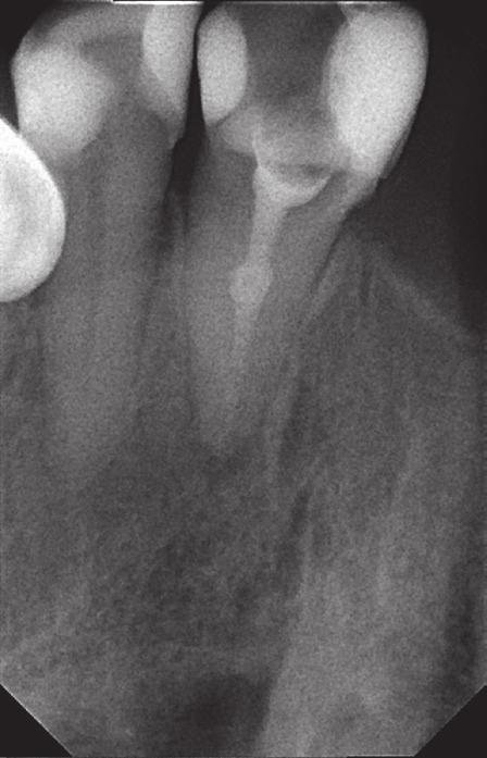 tooth 11 was diagnosed and the antiseptic root canal therapy using calcium hydroxide between visits was administered.