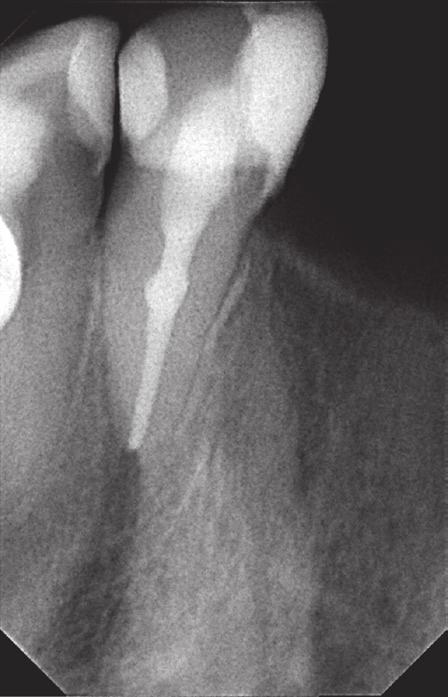 The step-back preparation of the root canal with Kerr files was performed, the diameter of the MAF was 30 according to ISO. Endogel was used as a lubricant (Chema Rzeszow, Poland).