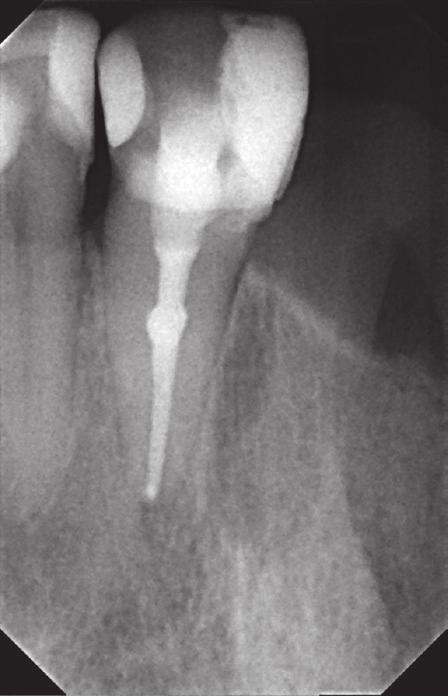 9% NaCl solution for final irrigation. Then, calcium hydroxide (Calxyl blue, OCO Präparate, Germany) was inserted into the pulp cavity as an antiseptic dressing for a period of three weeks (Fig. 6).