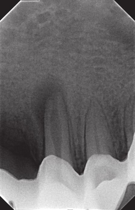 Treatment of internal inflammatory root resorption based on own observations J Stoma 2015; 68, 3 Fig. 9. Tooth 33 before treatment. Ząb 33 przed leczeniem. Fig. 10.