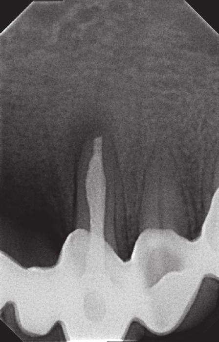 Case 3 A generally healthy female patient aged 58 years came to the dental office for treatment of tooth 33, which had been painful on biting for a week.