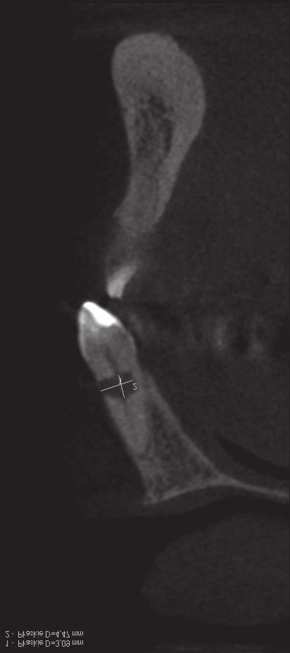 Treatment of internal inflammatory root resorption based on own observations J Stoma 2015; 68, 3 Fig. 12. Tooth 11 diagnostic RVG. Zdjęcie diagnostyczne RVG zęba 11. Fig. 13. Tooth 11 CBCT scan.