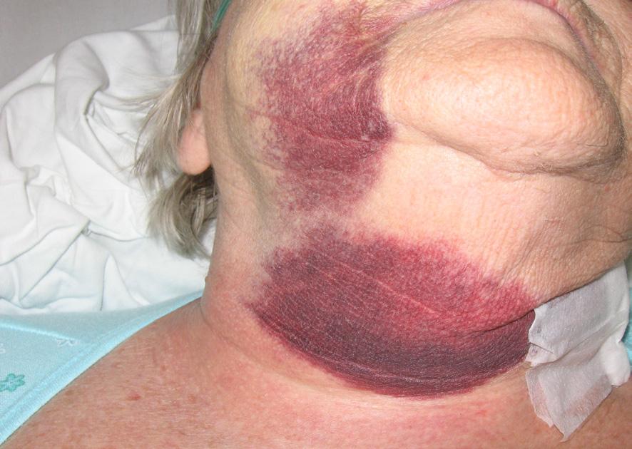Ginekologia i Perinatologia Praktyczna 2018, tom 3, nr 4 Patofizjologia nabytej hemofilii A Istotą AHA są zaburzenia układu immunologicznego z wytworzeniem przeciwciał neutralizujących koagulacyjną