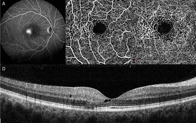 Varied optical coherence tomography angiography patterns at different stages of macular telangiectasia type analysis of 15 cases Fig. 1. Patient with Mac Tel, right eye (stage 1).