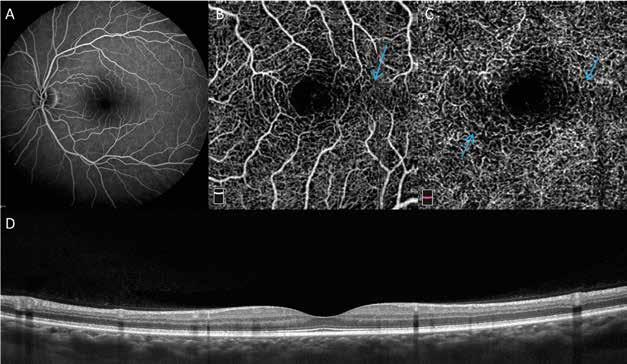 B, C OCT-A: dilated, irregular vessels temporally to the fovea, more pronounced in deep vascular network. C. D OCT-B scan: small intraretinal cavities and photoreceptors layer disruption temporally to the fovea.